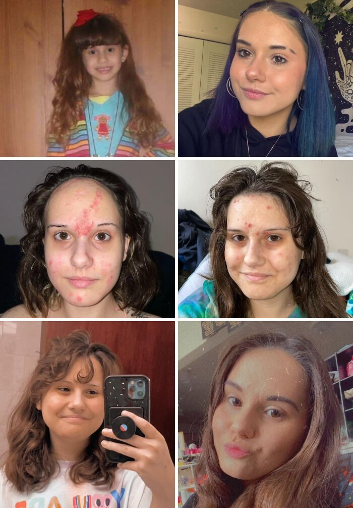"[6]-[11]-[13]-[15]-[18]-[20]-[21]-[22]x3-[23]x3-[24]-[26/Recent] I’ve Had A Wild Ride LOL (S/O To Lupus For Making Me Look Like A Zombie For 3ish Years 🤷‍♀️)"