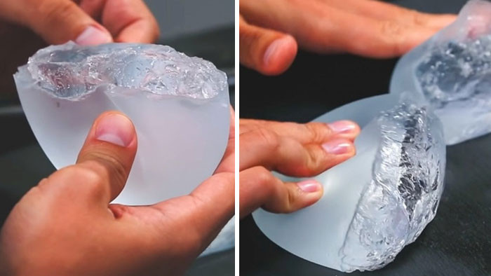44. What is contained within the breast implant?