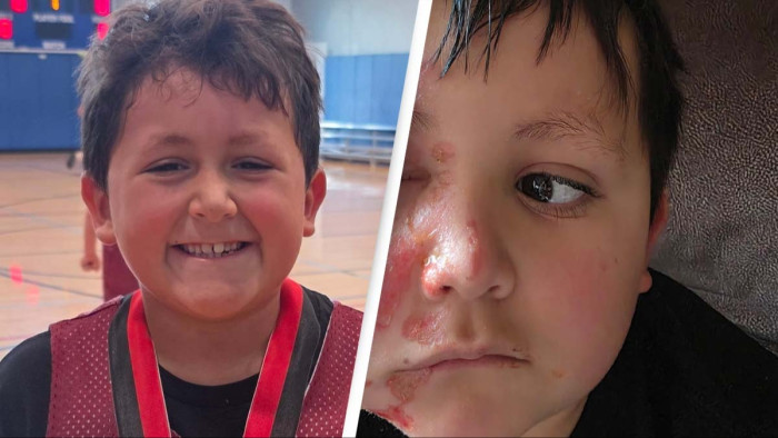 Family safety reminder, household items and viral challenges highlighted for burn prevention