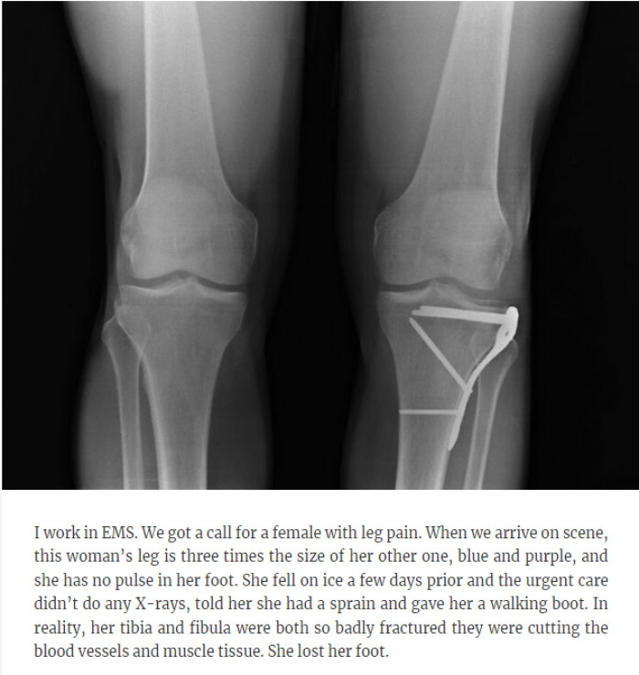 24. She lost her foot.