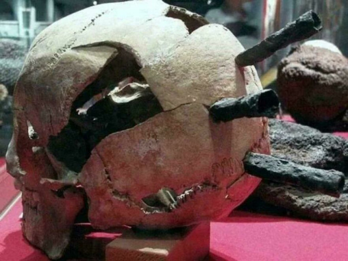 "Arrowheads in the Skull of a Man Who Passed in 1361 During the Battle for the Swedish City of Visby (Gotland Island)"