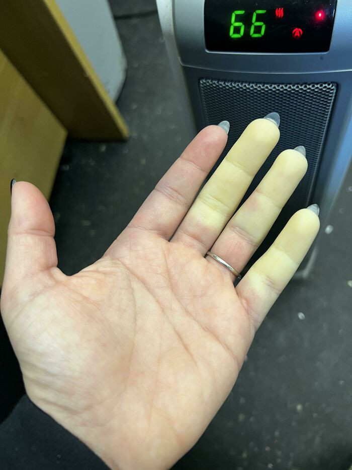 "Raynaud’s Syndrome (Phenomenon) On My Hand This Morning"