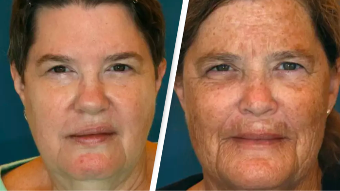 Close-up twin faces showing smoking-related wrinkles, reduced collagen, and elasticity.