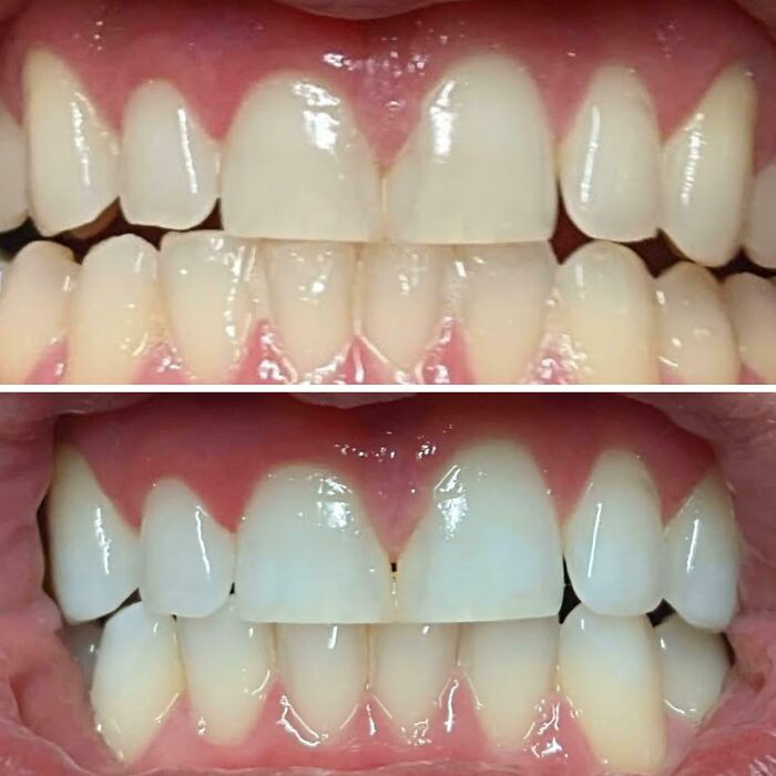 "Before And After Going Through A Box Of Crest White Strips"