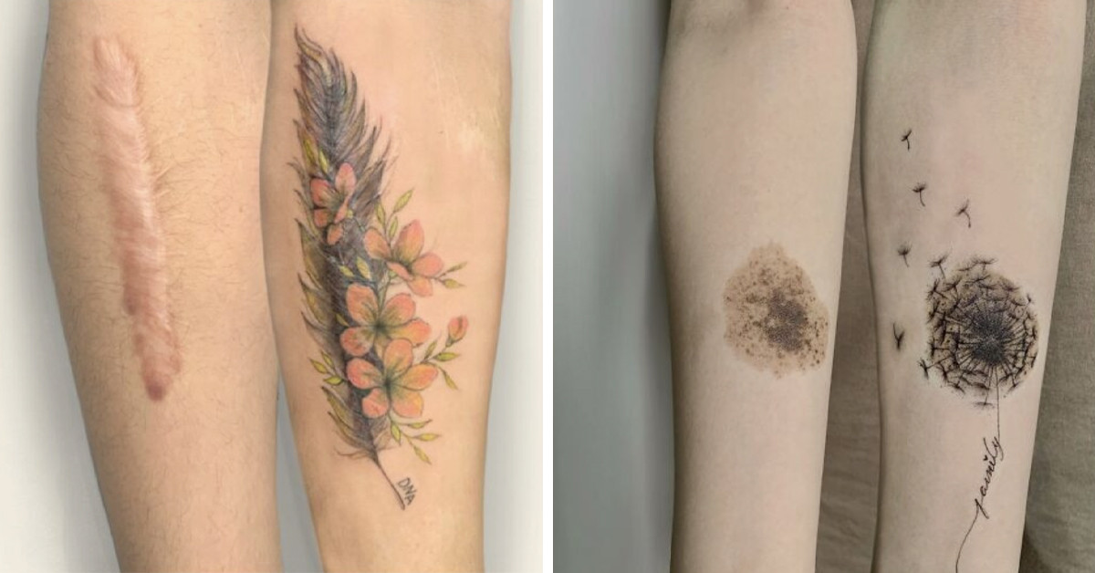 50 Times People Covered Up Their Scars With Adorable Tattoos Courtesy Of A Talented Artist