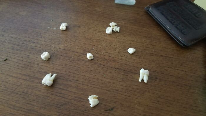 Usually people get 4 wisdom teeth, but this person's different.