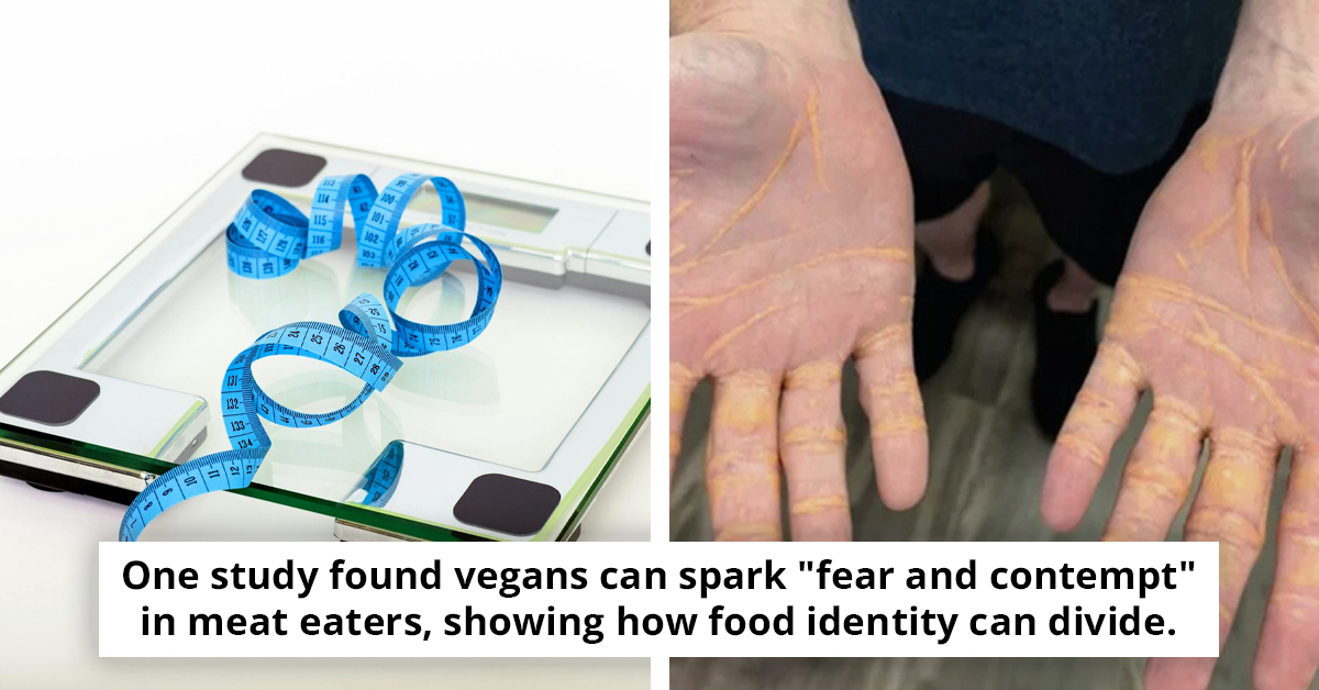 Carnivore Diet Leads To Unbelievable Health Scare As Cholesterol Leaks From Hands And Feet