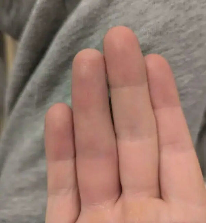 "I Broke My Ring Finger And After Not Bending It For A While, I'm Losing My Crease On The Top Joint"