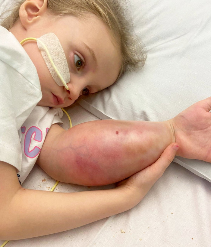Young girl holding arm, medical care context for rare rhabdoid sarcoma diagnosis