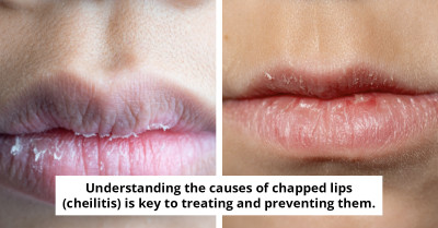 Expert Uncovers Surprising Reasons Behind Persistent Chapped Lips