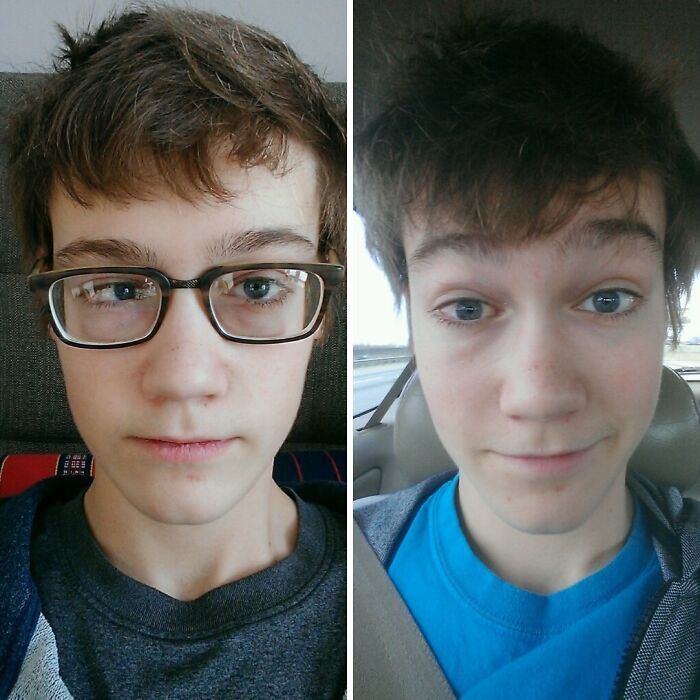 "My Crosseye (Strabismus) Surgery Before And After: Update: 3 Weeks Later!"