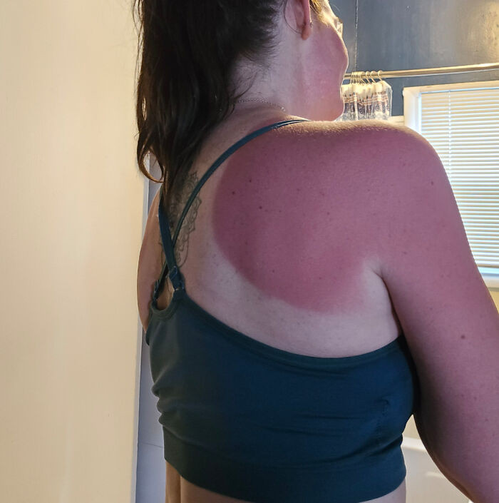 "Was Helping My Husband Do Yard Work For An Elderly Lady And Forgot To Take Sunscreen!"