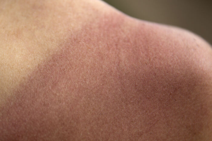 13. “When you get a sunburn, your cells are dying to avoid becoming cancerous”