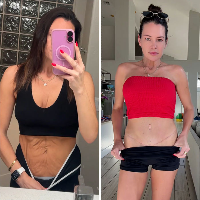 Cayley - Mommy makeover