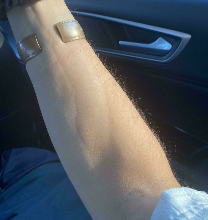 "Sometimes My Veins Are Sunken Instead Of Raised"