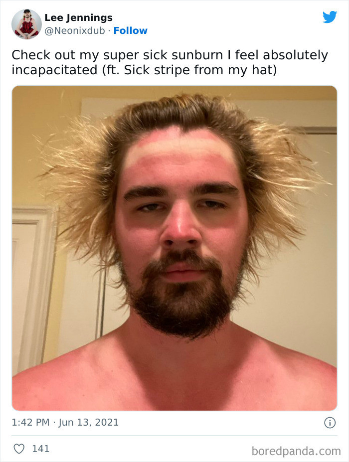 10. Which is worse, the sunburn or the hair?