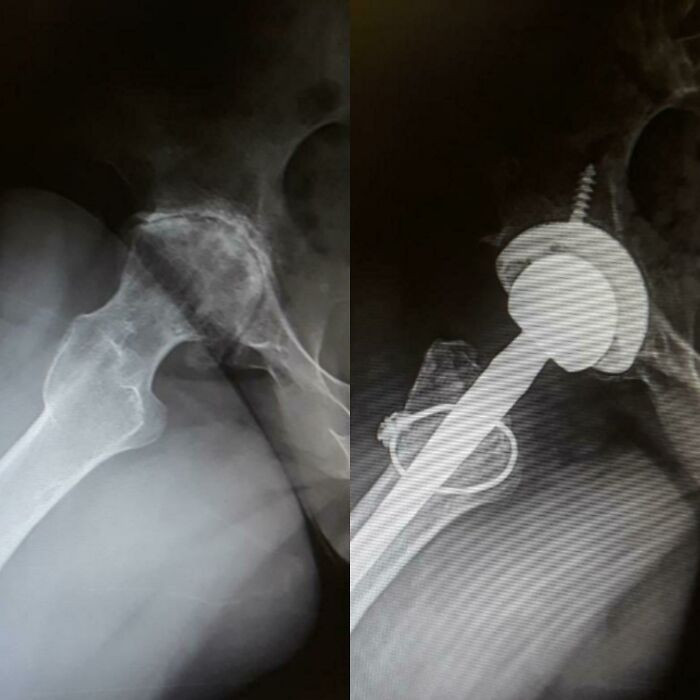 "Before And After Hip Replacement Surgery"