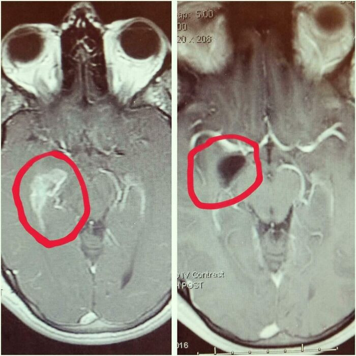 "My Brain Before And After Brain Surgery"