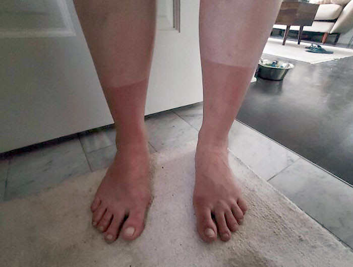 7. Socks made of sunburn.