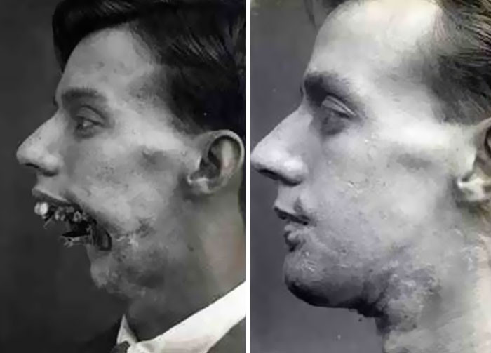 "Facial Reconstructive Surgery From 1916"