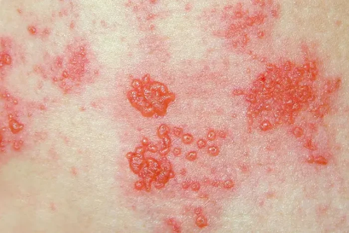 Why Shingles Cases May Be Rising Among Millennial Women