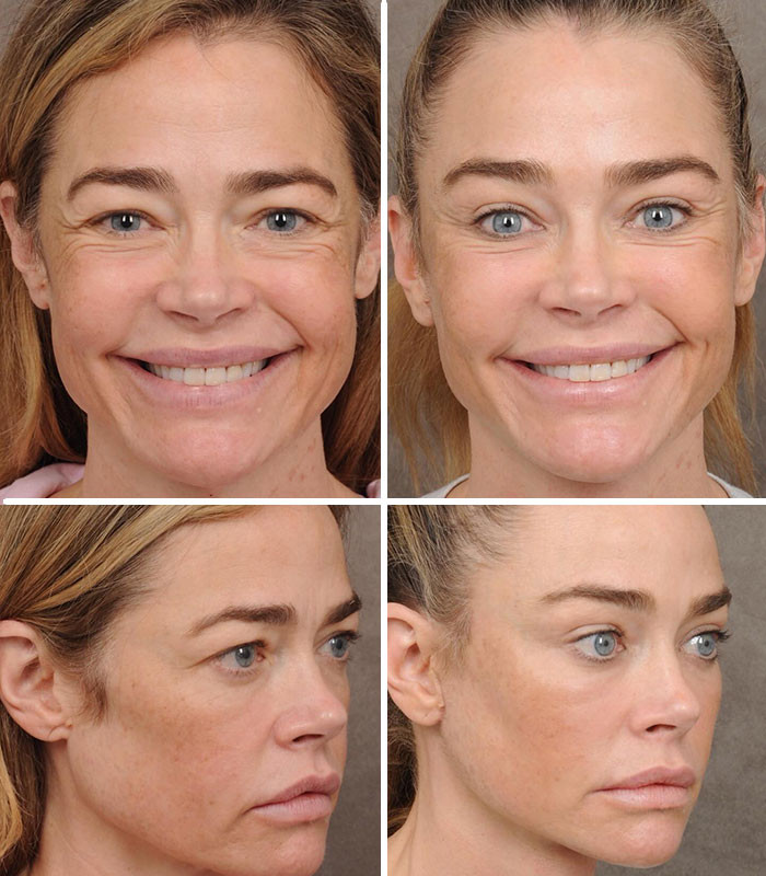 Denise Richards - Facelift