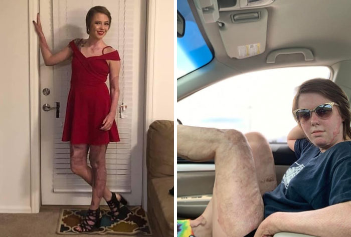 13. Hey Mom, I Wore A Dress For The First Time Since I Was In An Explosion. It Was So Scary Showing My Scars For The First Time. But I Did It And I Still Felt Beautiful