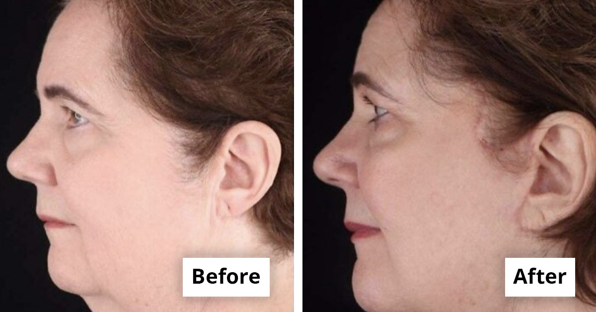 Before-and-after Photos Reveal How Cosmetic Surgery Moved Into The Mainstream