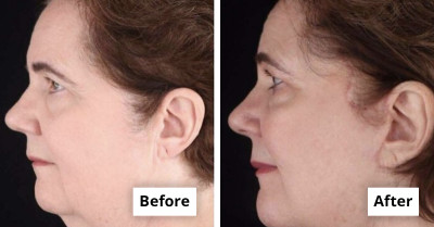 Before-and-after Photos Reveal How Cosmetic Surgery Moved Into The Mainstream
