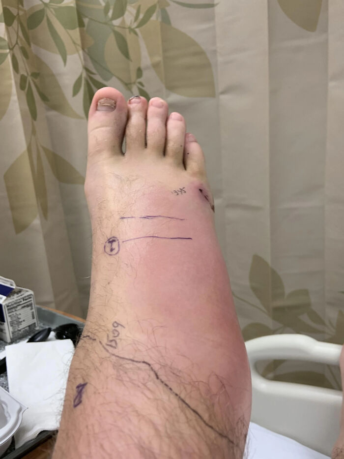 12. This Foot Two Days After A Rattlesnake Bite