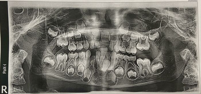 "My 6-Year-Old's Dental X-Ray"
