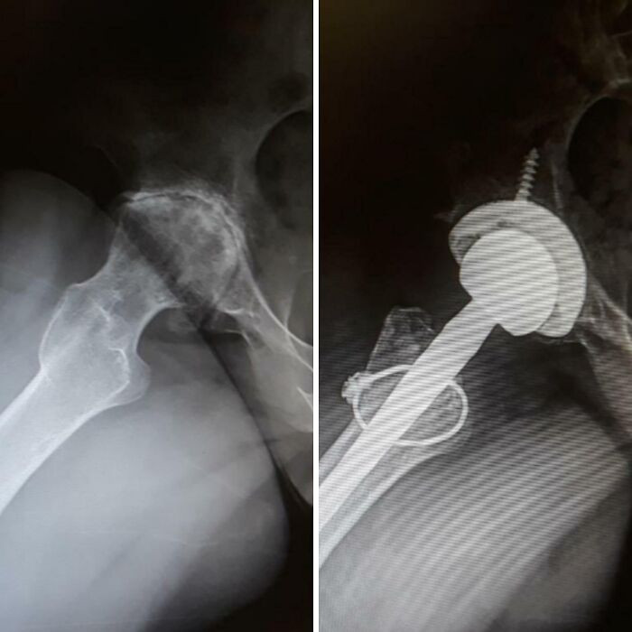 "Before And After Hip Replacement Surgery"