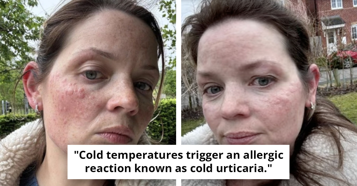 Discover the Struggles of a Woman with a Rare Condition Triggered by Cold Weather