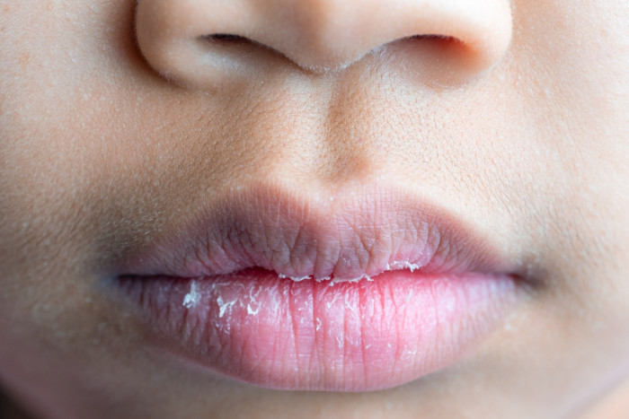 Close-up of cracked, chapped lips with winter dryness and lip care tips