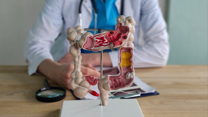 Medical professional discussing early colorectal cancer detection and treatment challenges
