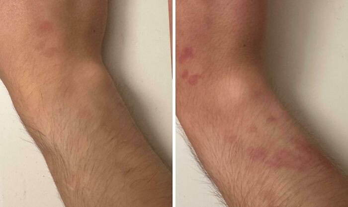 "I Have A Birthmark That Becomes More Visible When I Am Stressed"