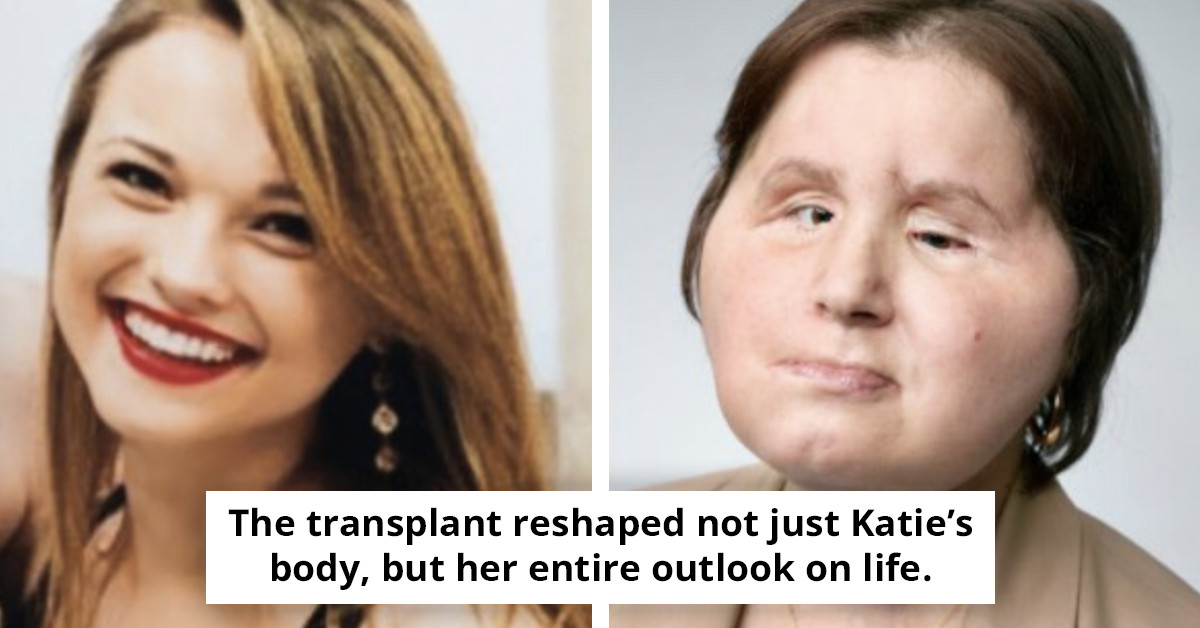 A Tale of Resilience: Katie Stubblefield's Journey to Becoming the Youngest Face Transplant Recipient in the US