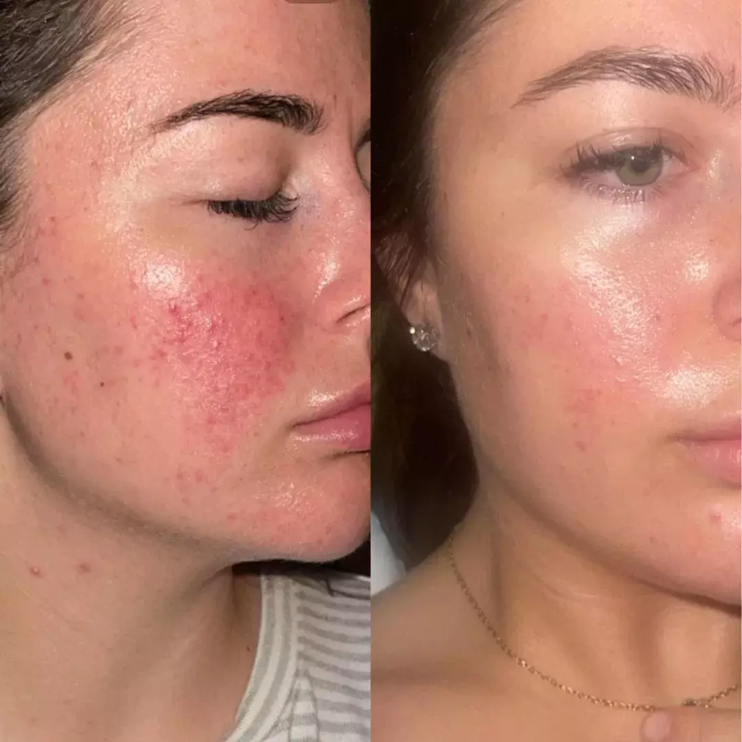 So, what makes it different? The secret lies in its main ingredient: silver chitoderm, a fusion of silver and chitosan (a natural compound derived from shellfish).