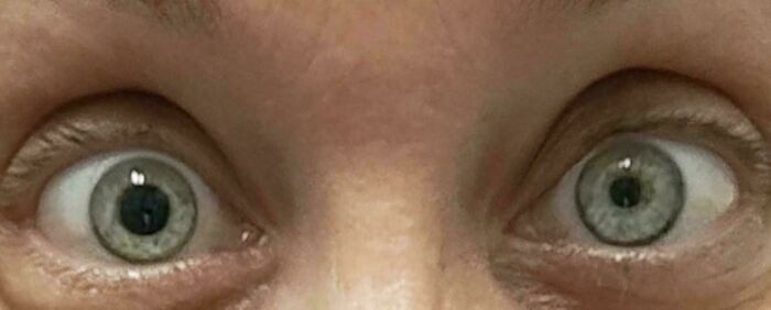 "Difference In The Size Of My Pupils After A Box Fell On My Head At Work"