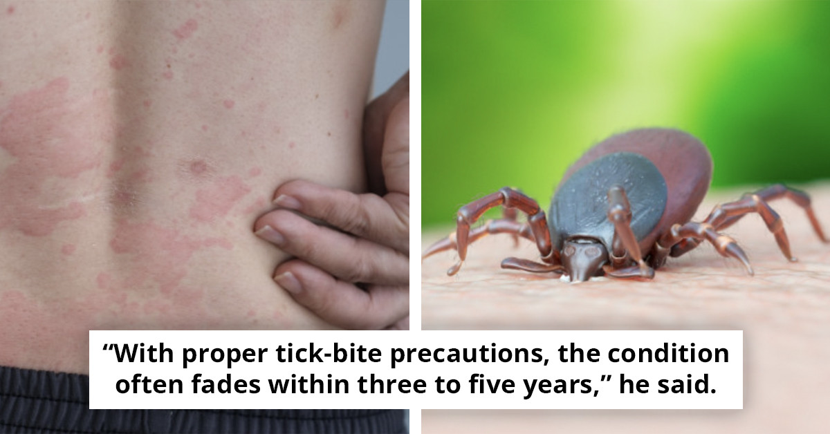 Unveiling Alpha-Gal Meat Allergy: Insights Following Tragic Incident from Hamburger Consumption