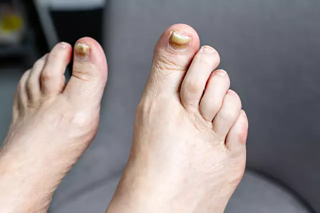 Thick Toenails Could Indicate a Deeper Health Issue