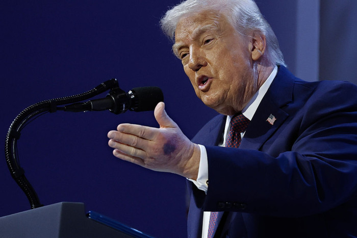 Trump speaks at an event, addressing concerns about a hand bruise