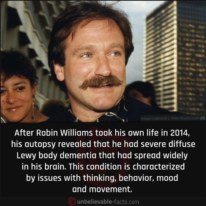 30. Severe Diffuse Lewy Body Dementia