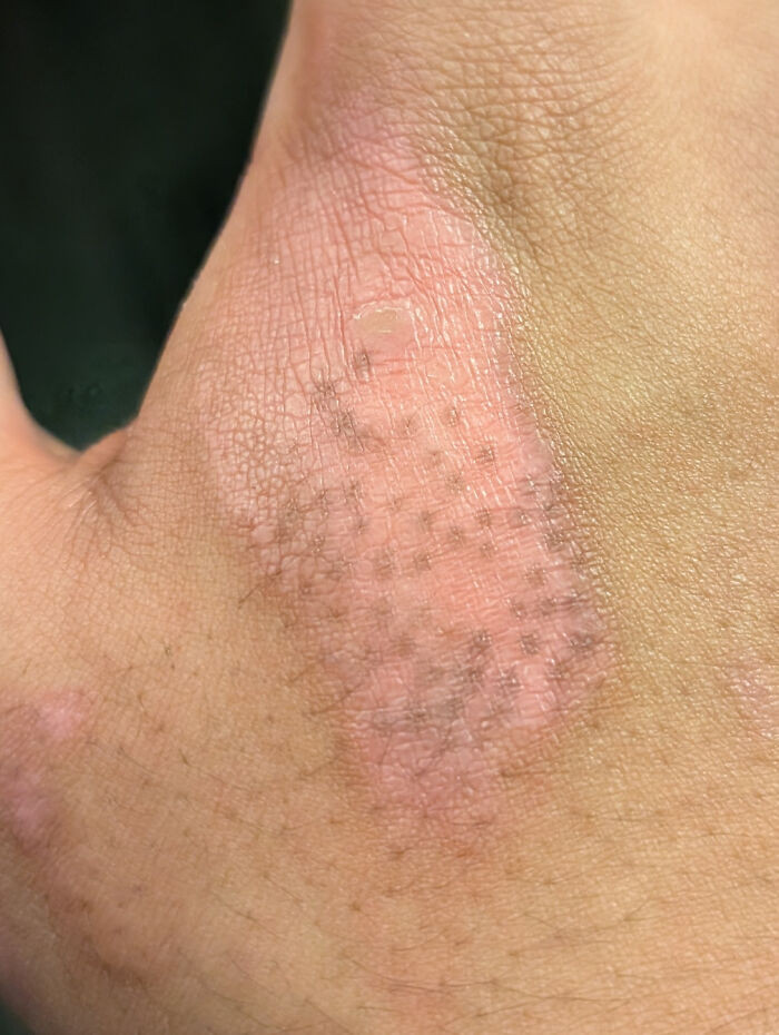 "The Way The Color Is Coming Back On My Burn Wound"