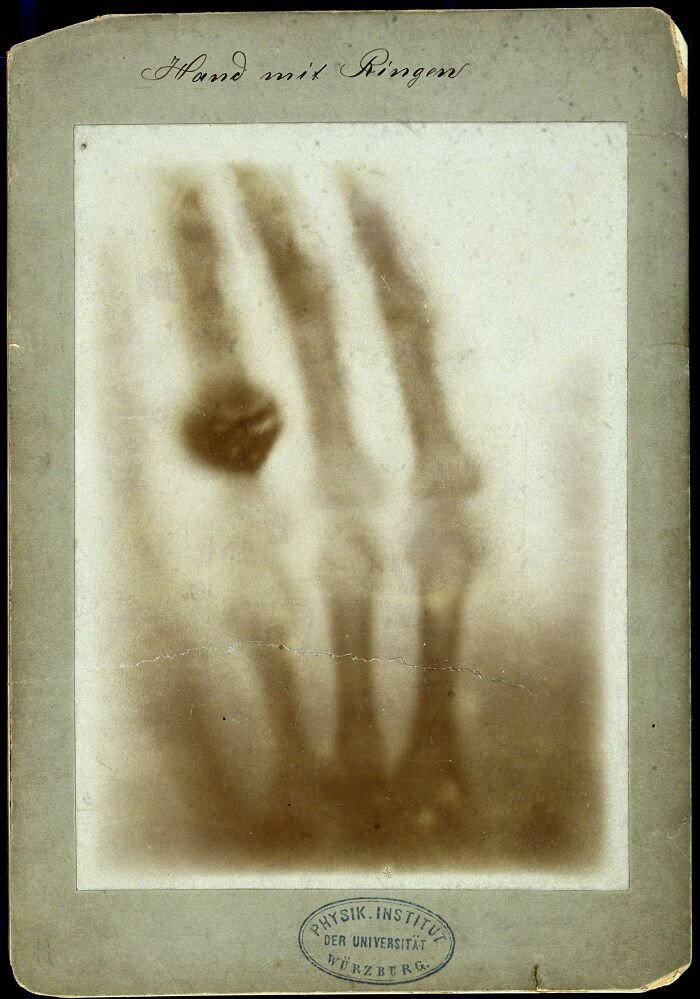 "The First X-Ray Image, “Hand Mit Ringen” By Wilhelm Conrad Roentgen, 1895"