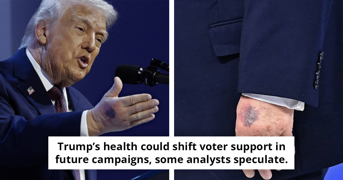 Trump addresses concerns over hand bruise following recent photos.