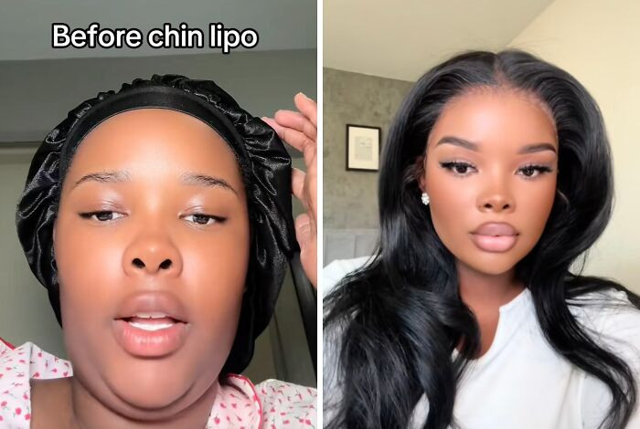 11. Chin lipo.