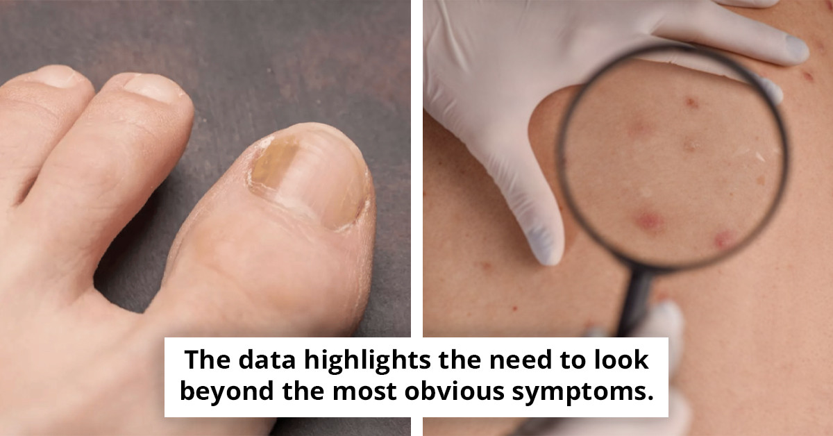 Medical experts alert the public to a rare cancer indicator visible on toenails.