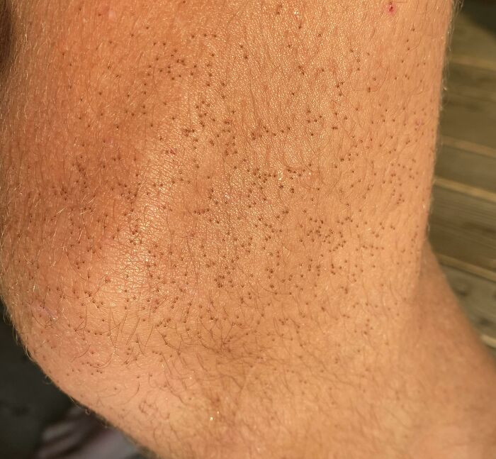 After Going On A Walk, I Was Horrified To Find That I Was Covered With Tiny Ticks. Stay Safe Out There