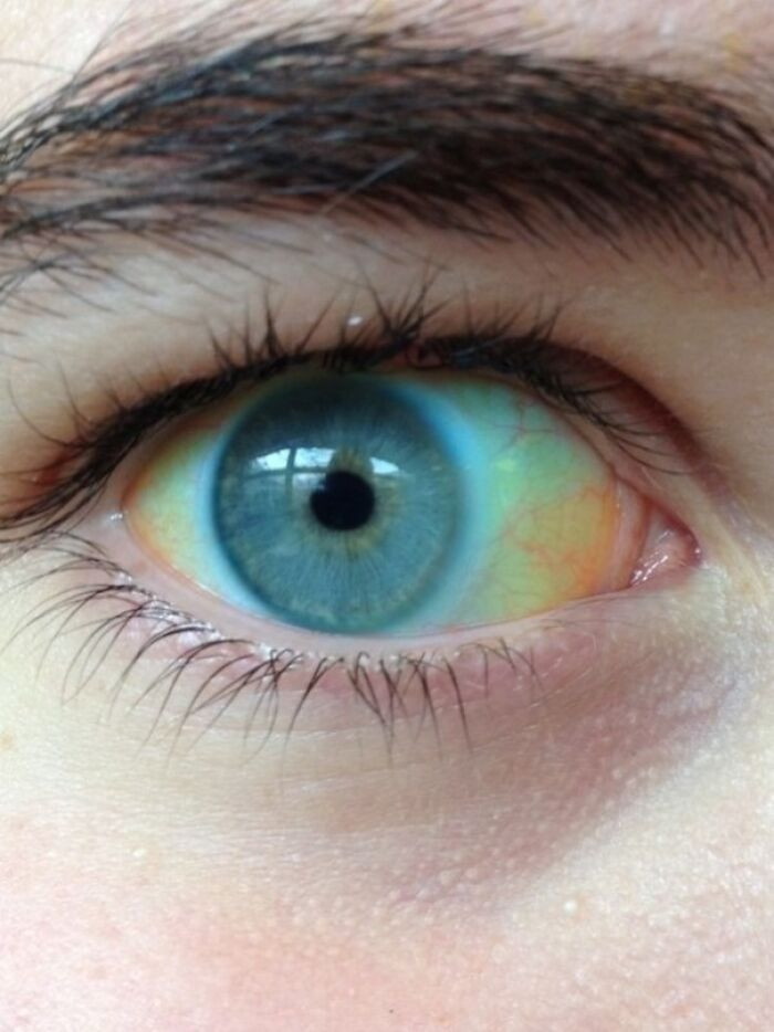 "The White In My Eye Is Yellow"